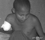 Abdulekerim, age 15, lost his right arm on Butajira conflict